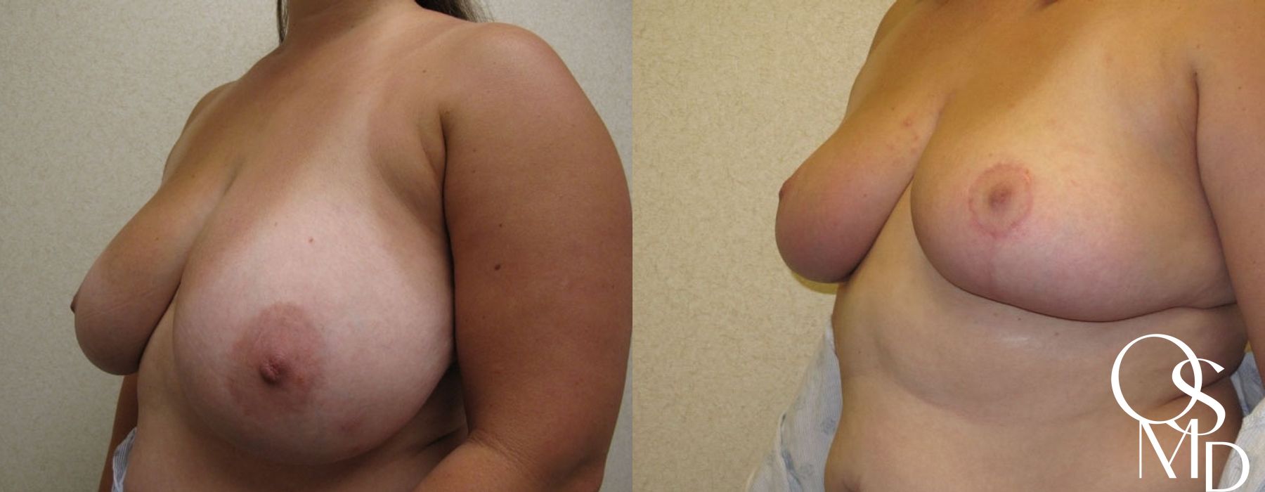 Before and after Breast Reduction case 16780 - Angle 2