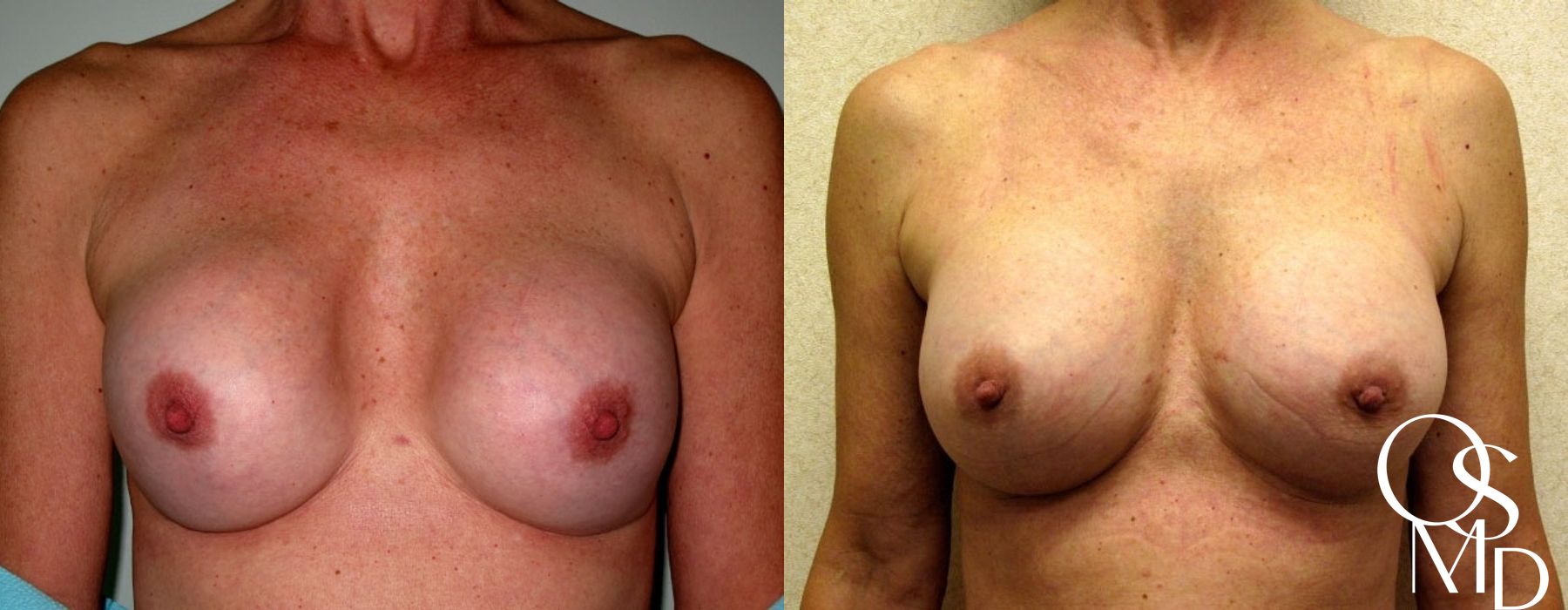 Before and after Breast Revision case 16779