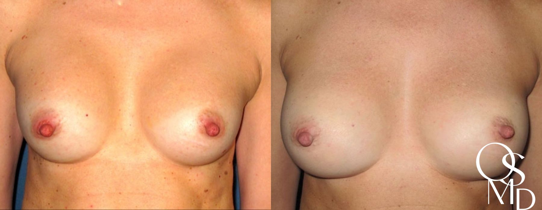 Before and after Breast Revision case 16764