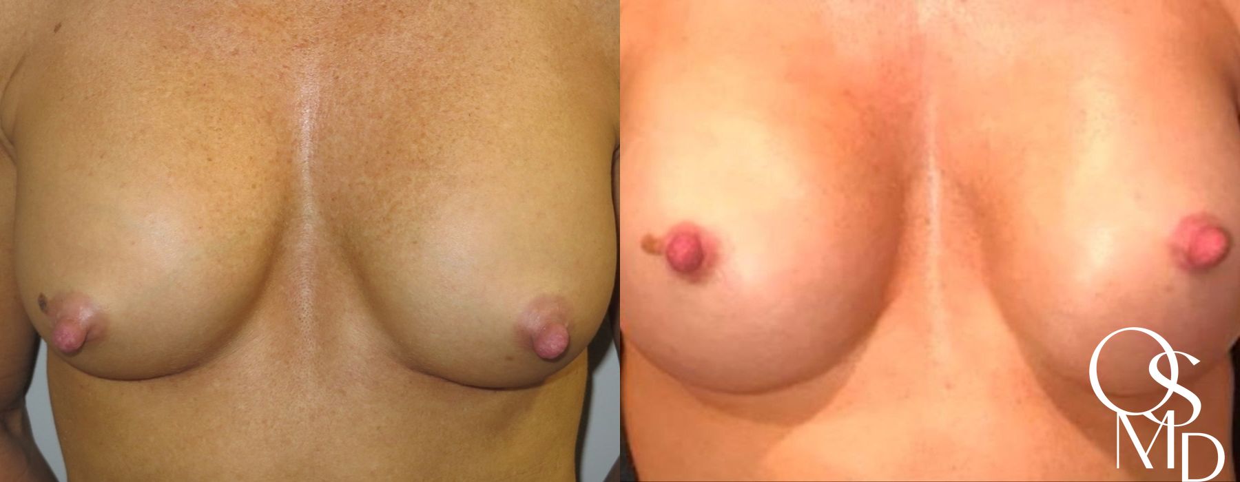 Before and after Breast Revision case 16739