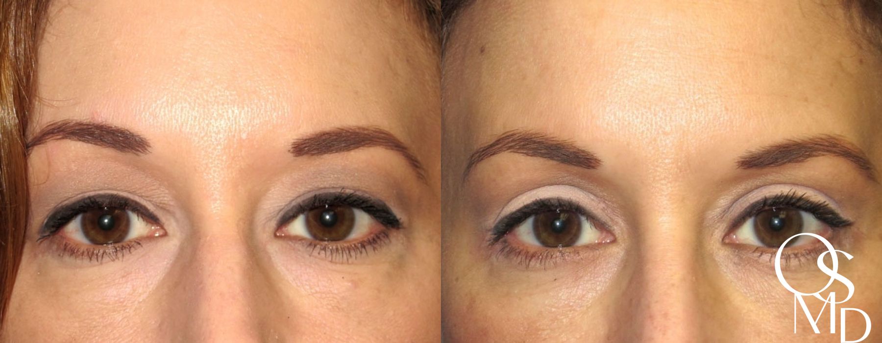 Eyelid Lift - Case 241064