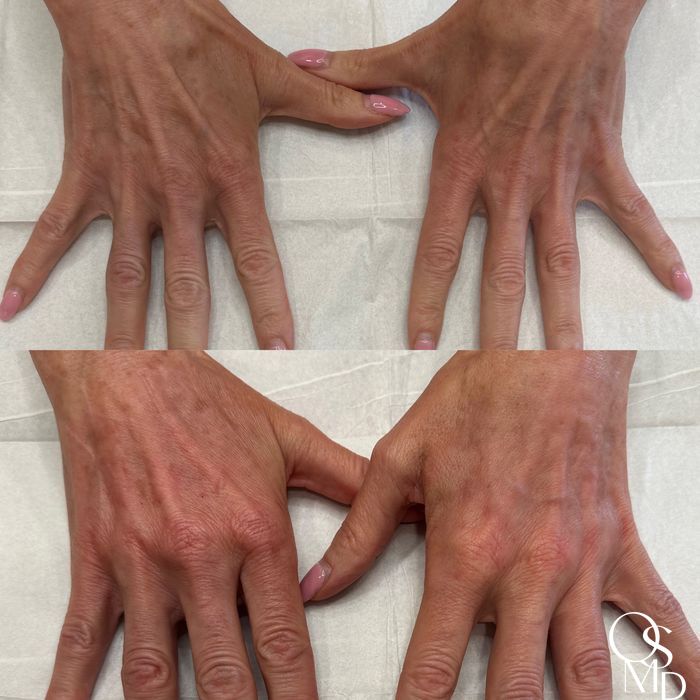 Before and after Fillers case 18490