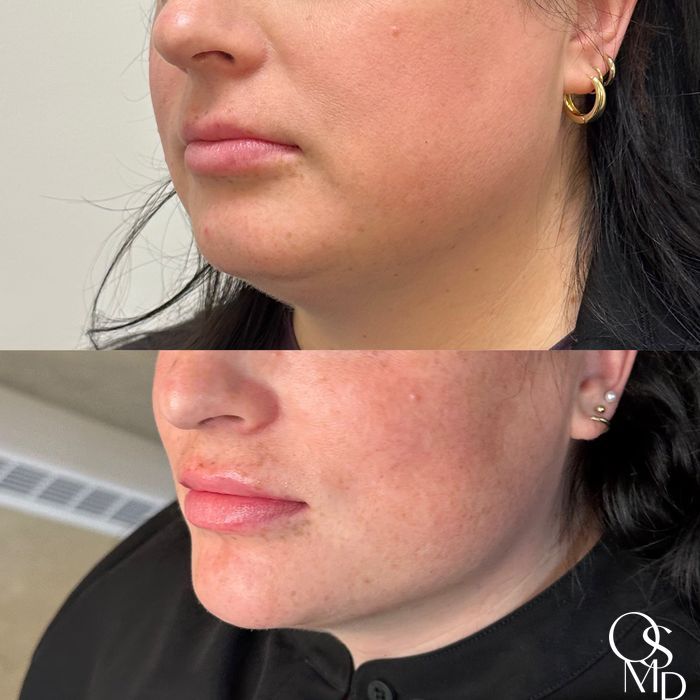 Before and after Fillers case 19347