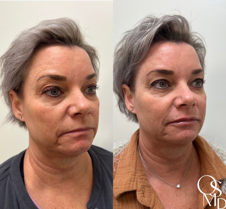 Before and after Fillers case 19349