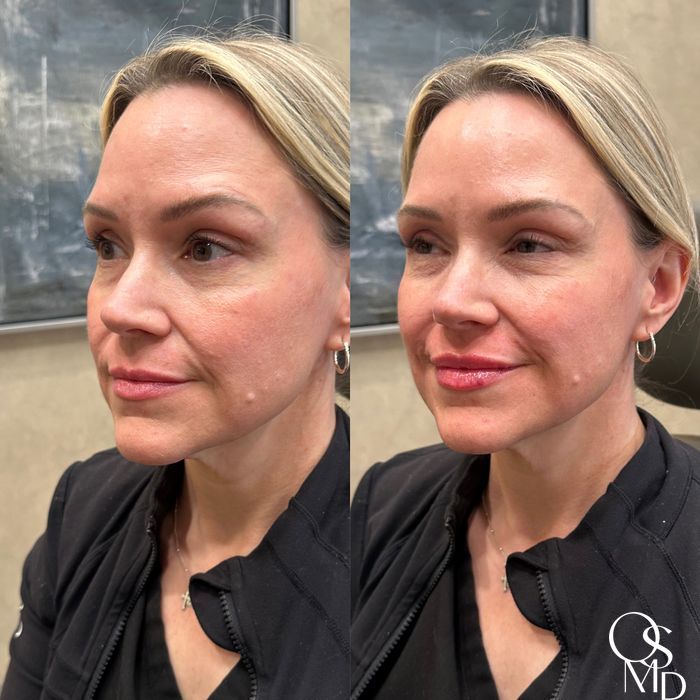 Before and after Lip Filler case 19345