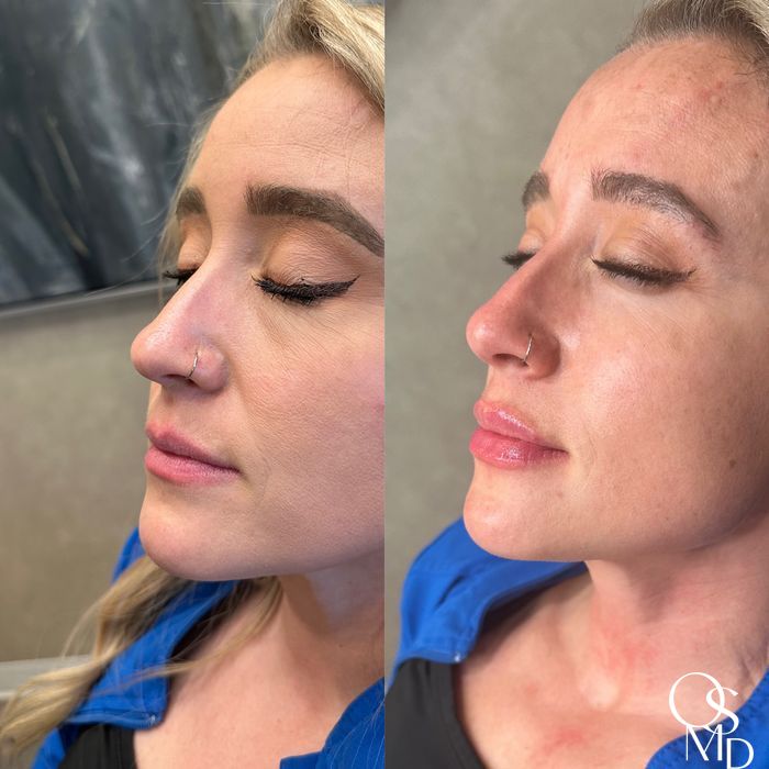 Before and after Lip Filler case 18568