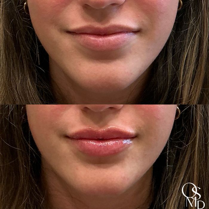 Before and after Lip Filler case 18482