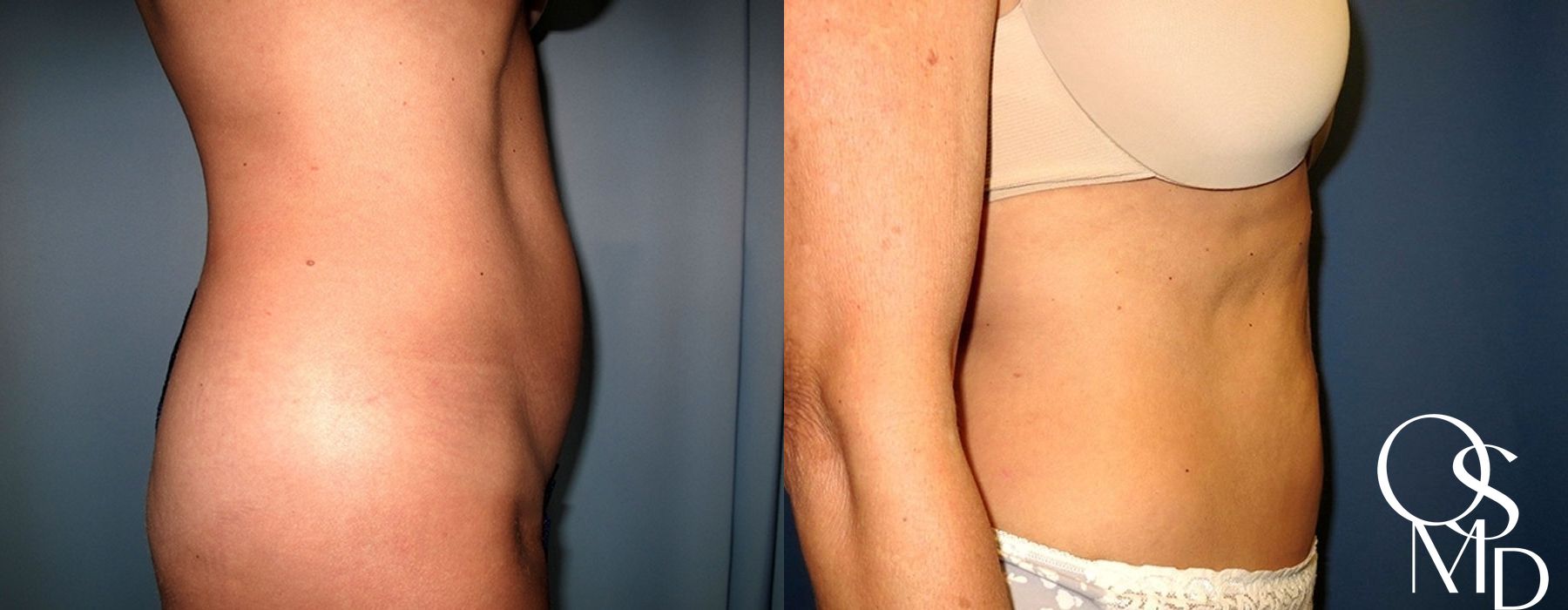 Before and after Liposuction case 16777 - Angle 3