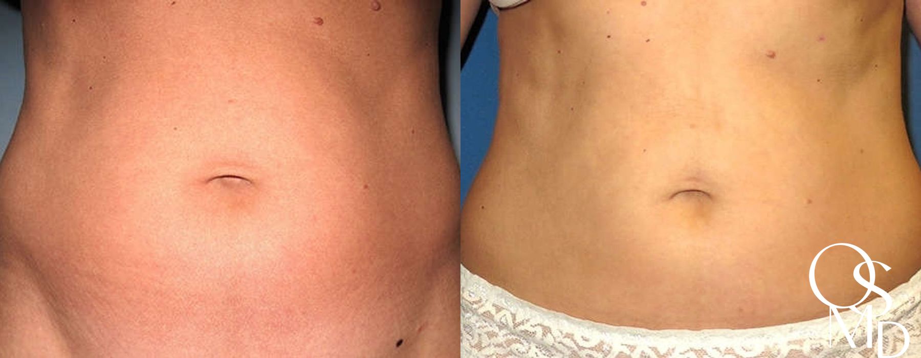 Before and after Liposuction case 16777