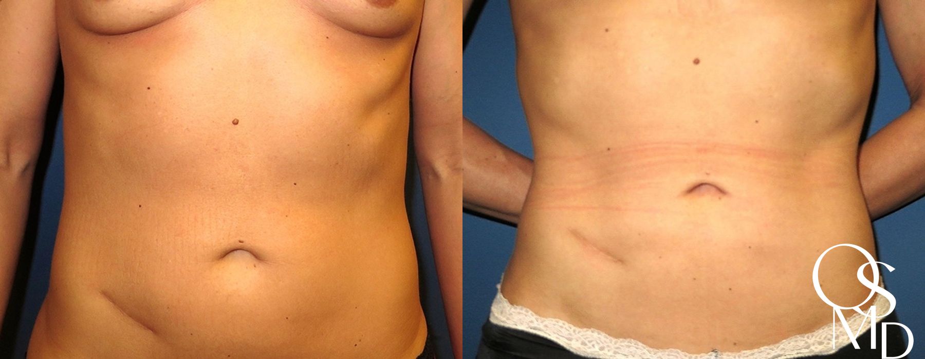 Before and after Liposuction case 16776 - Angle 2
