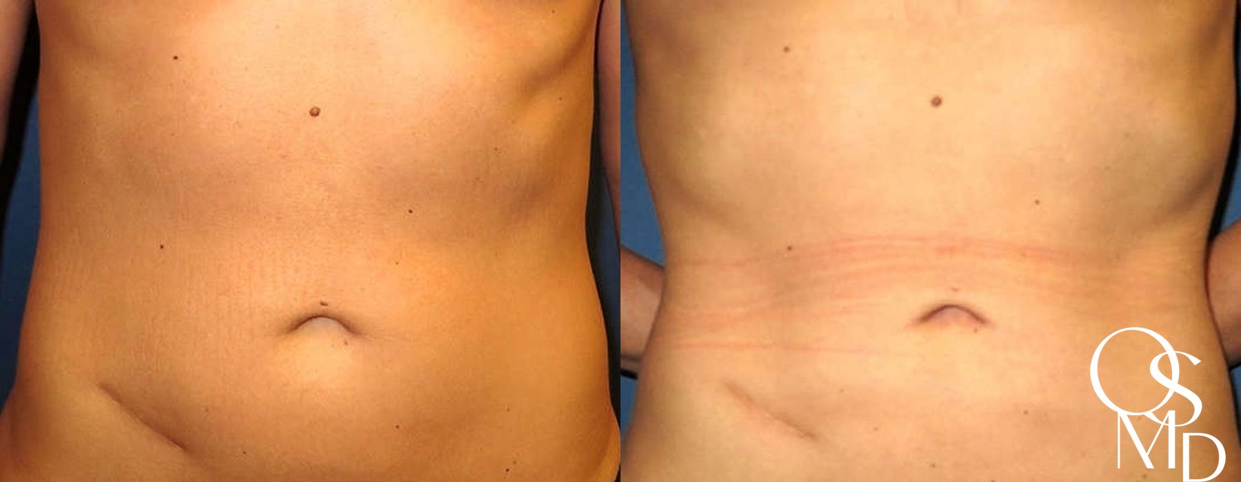 Before and after Liposuction case 16776