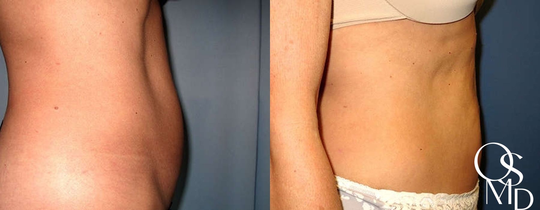 Before and after Liposuction case 16777 - Angle 2