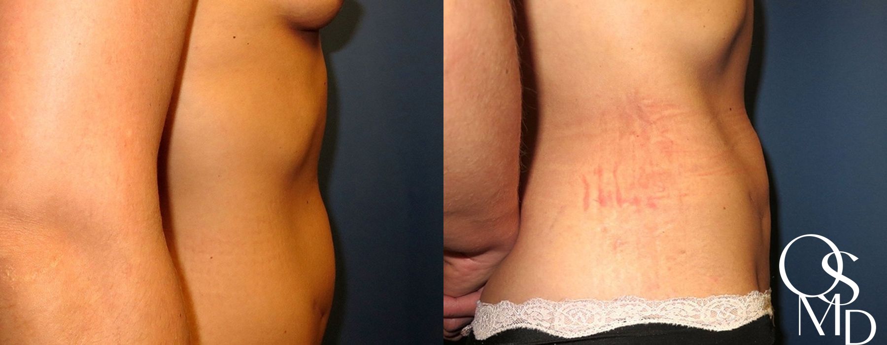 Before and after Liposuction case 16776 - Angle 3