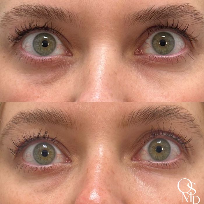 Before and after PDGF+ case 18493