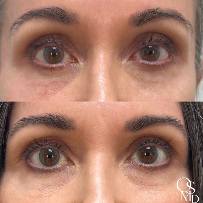 Before and after PDGF+ case 18489