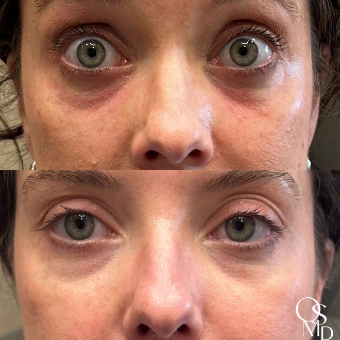 Before and after PDGF+ case 18487