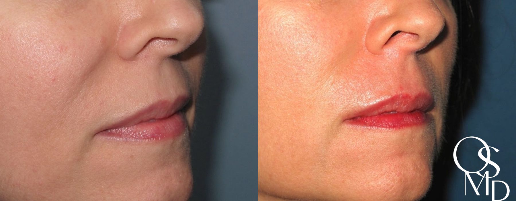 Before and after Juvederm case 16774 - Angle 2