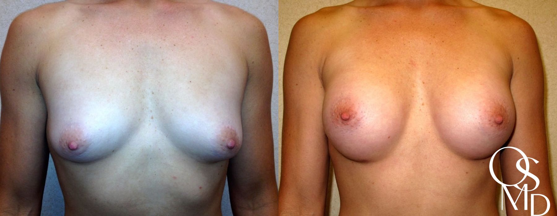 Before and after procedure result