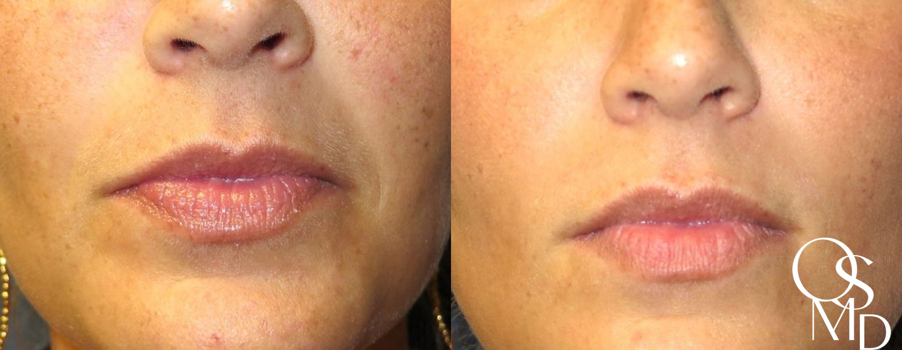 Before and after Juvederm case 16773