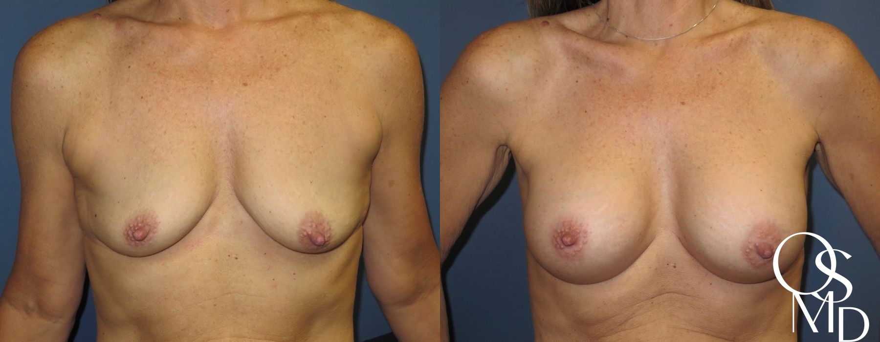 Before and after procedure result