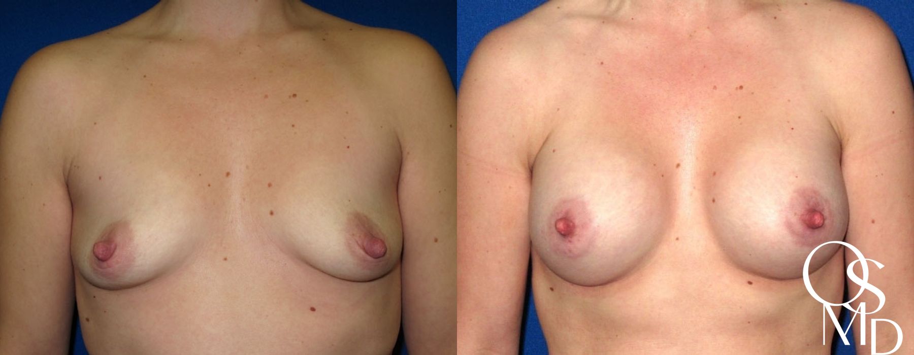 Before and after procedure result