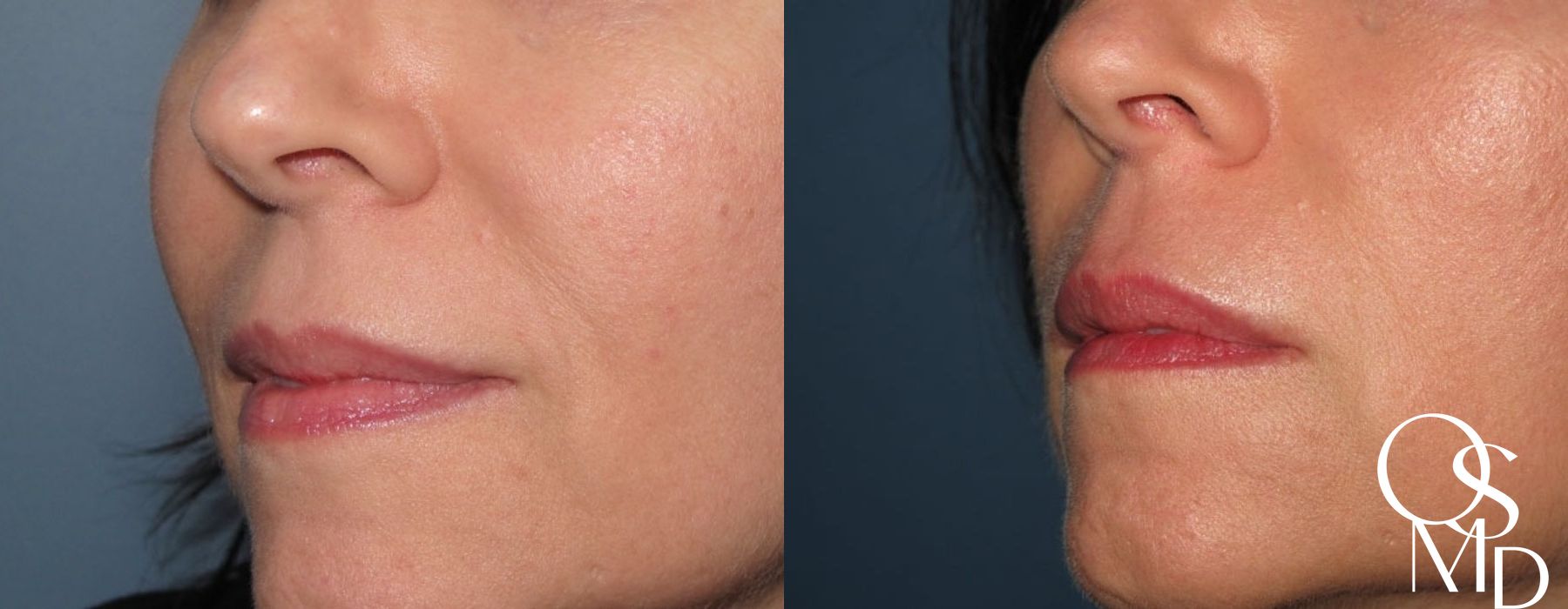 Before and after Juvederm case 16774