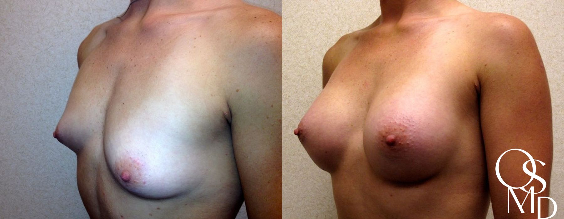 Breast Augmentation - Thumbnail 2