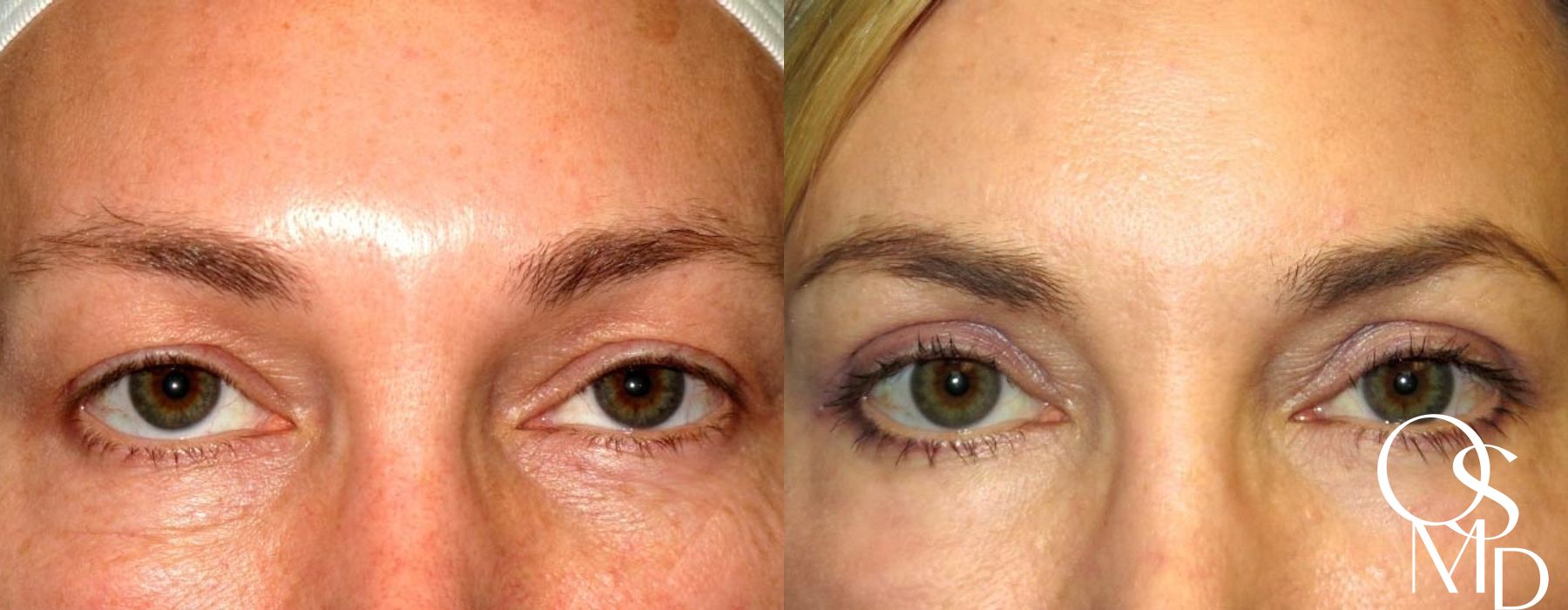 Eyelid Lift - Case 241065