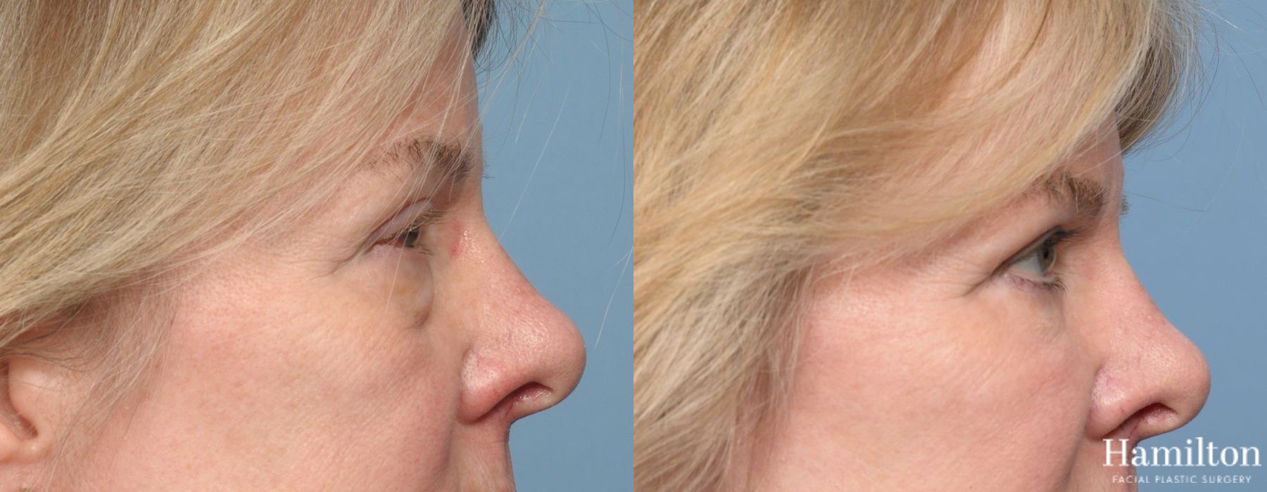 Before and after Blepharoplasty case 37230 - Angle 2