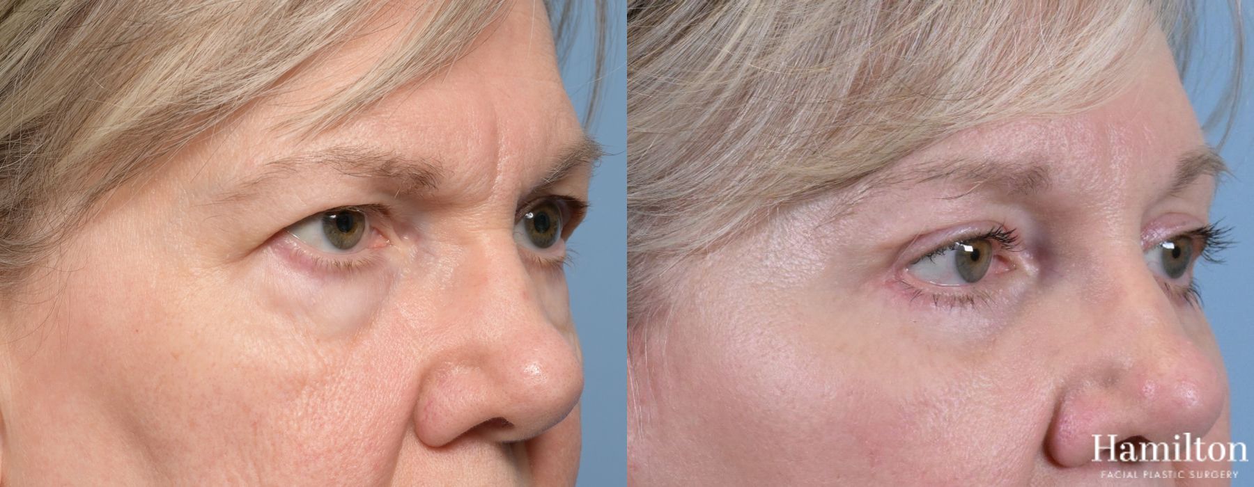 Before and after Blepharoplasty case 37195 - Angle 4