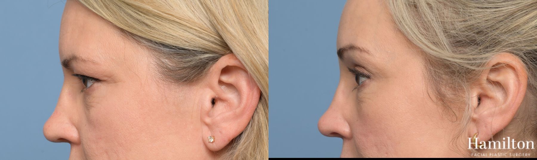 Before and after Blepharoplasty case 37175 - Angle 2