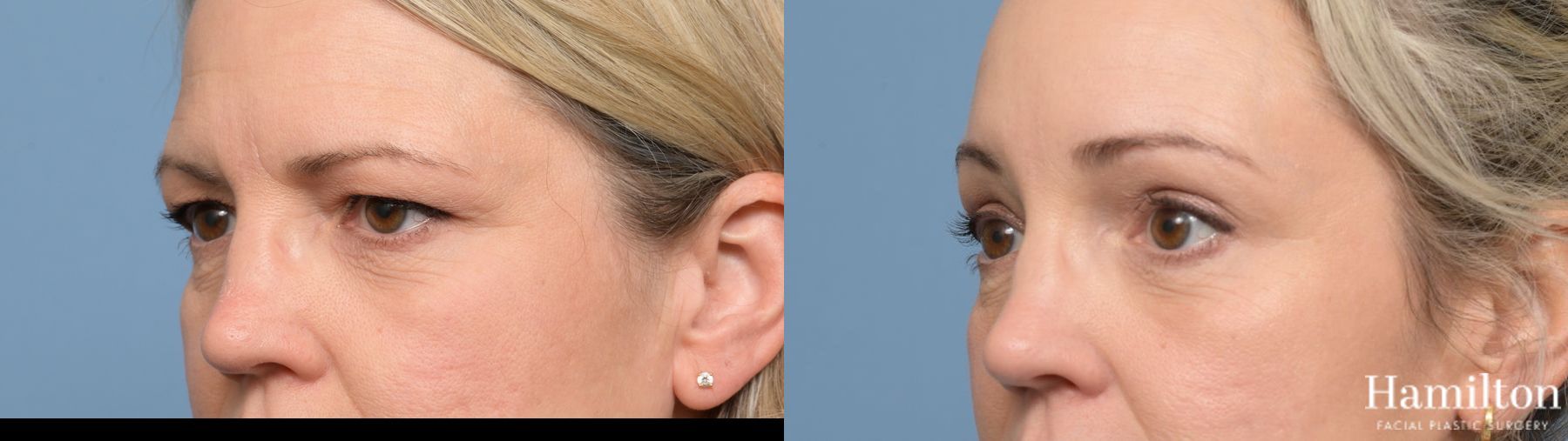 Before and after Blepharoplasty case 37175