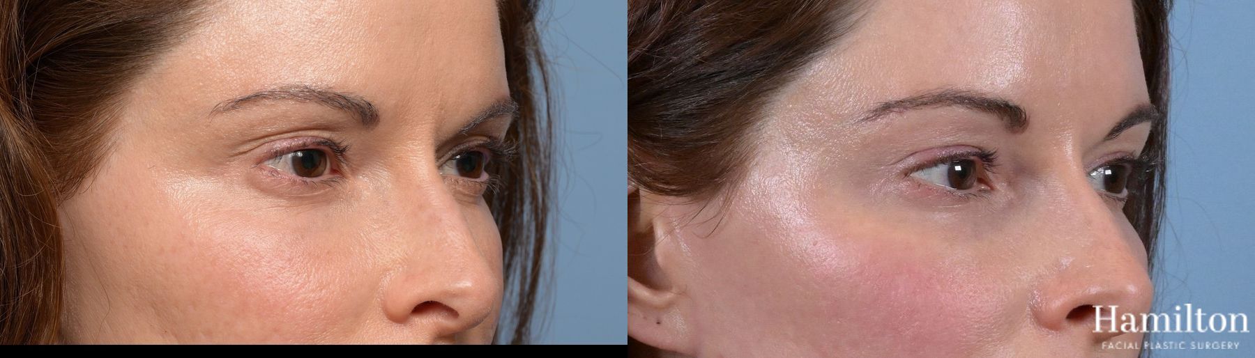 Before and after Blepharoplasty case 37169 - Angle 2