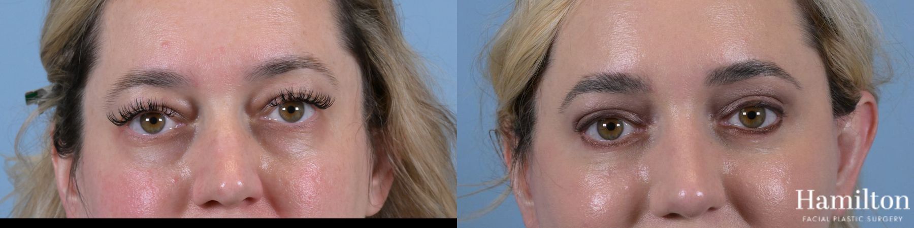 Before and after Blepharoplasty case 37133