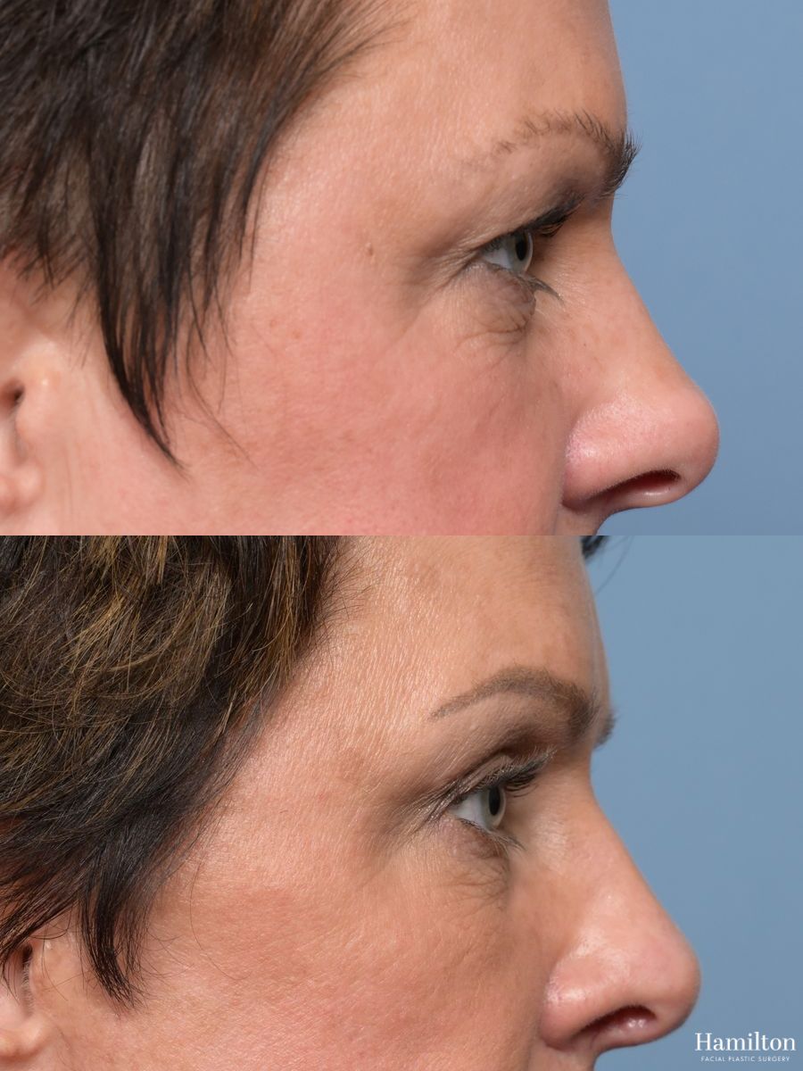 Before and after Blepharoplasty case 49399 - Angle 3