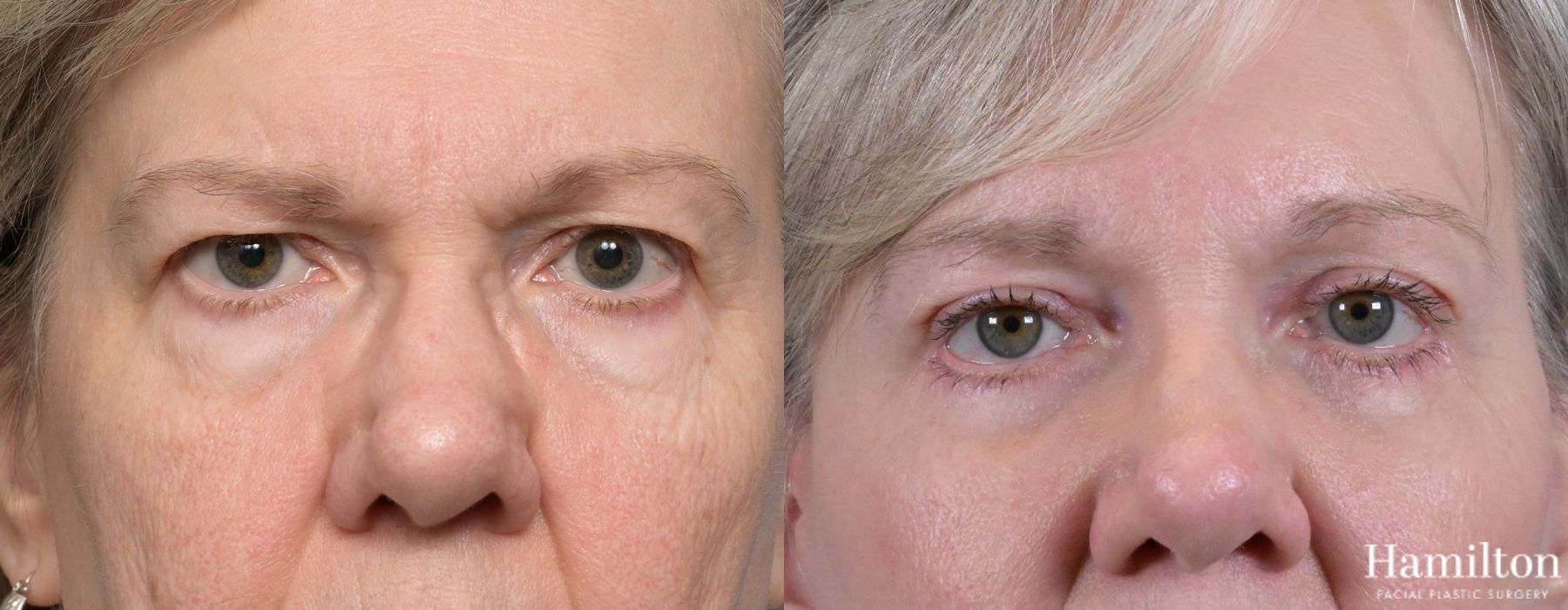 Before and after Blepharoplasty case 37195