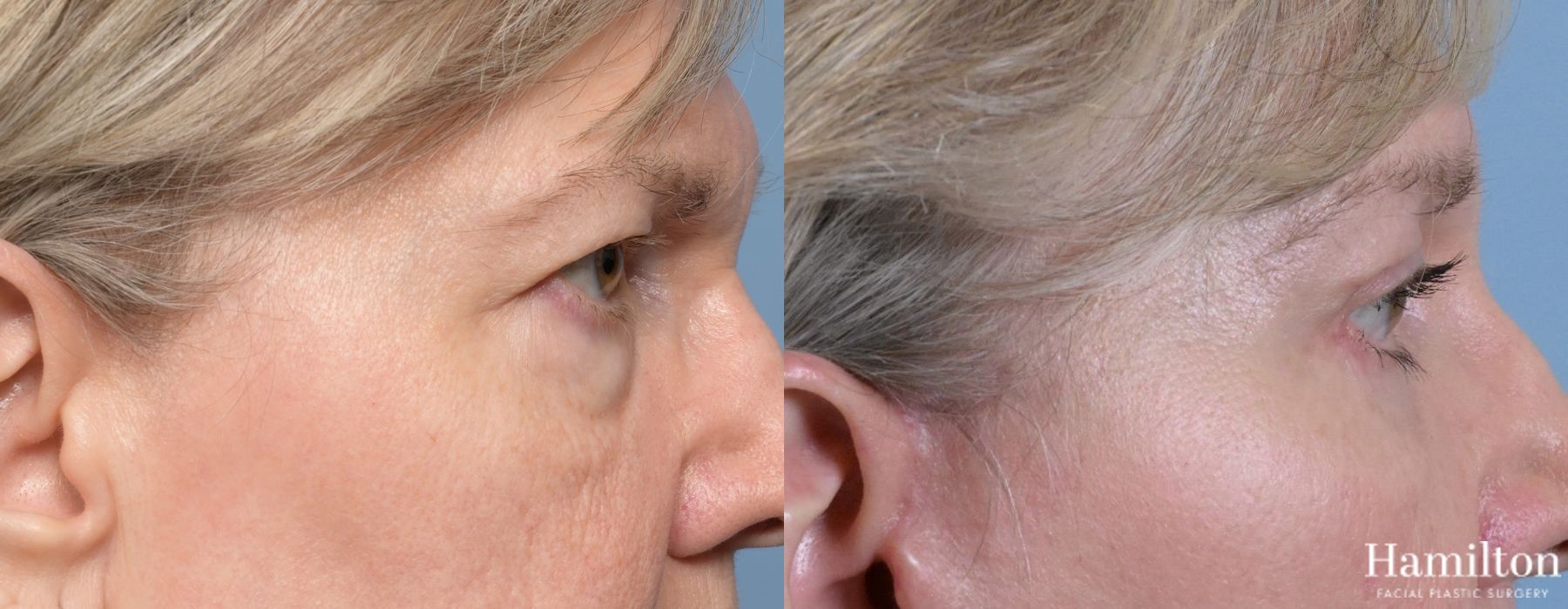 Before and after Blepharoplasty case 37195 - Angle 3