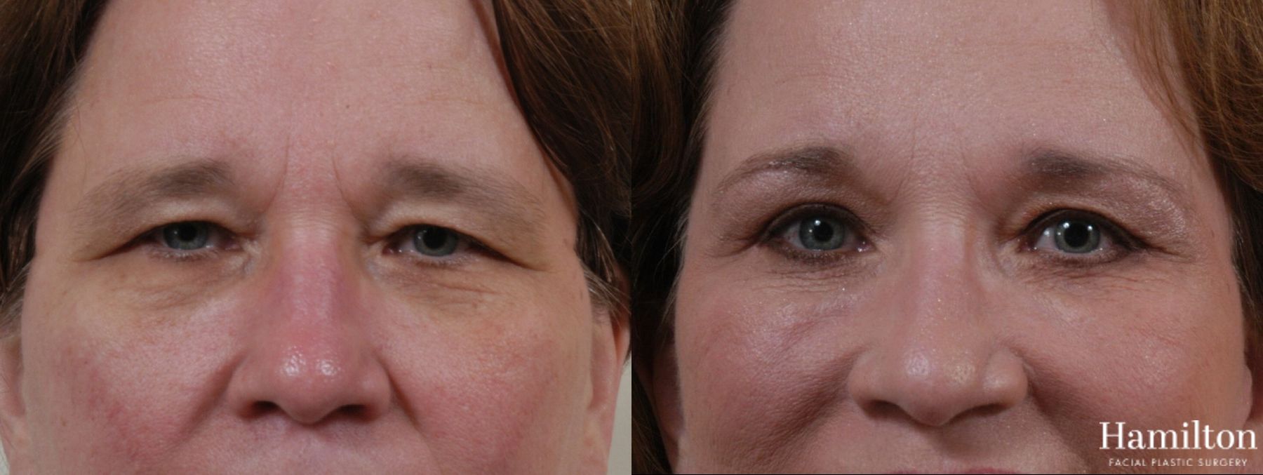 Before and after Blepharoplasty case 37270