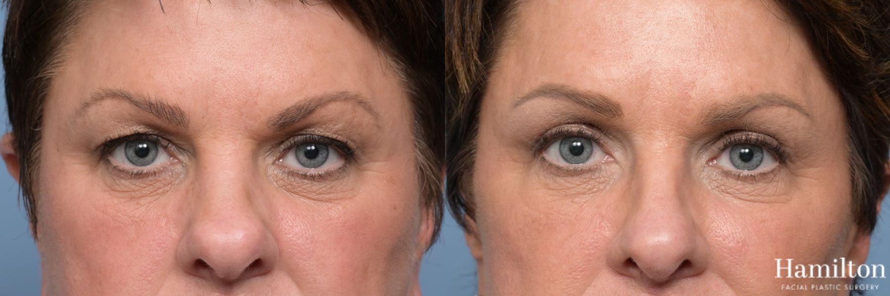 Before and after Blepharoplasty case 49399 - Angle 5