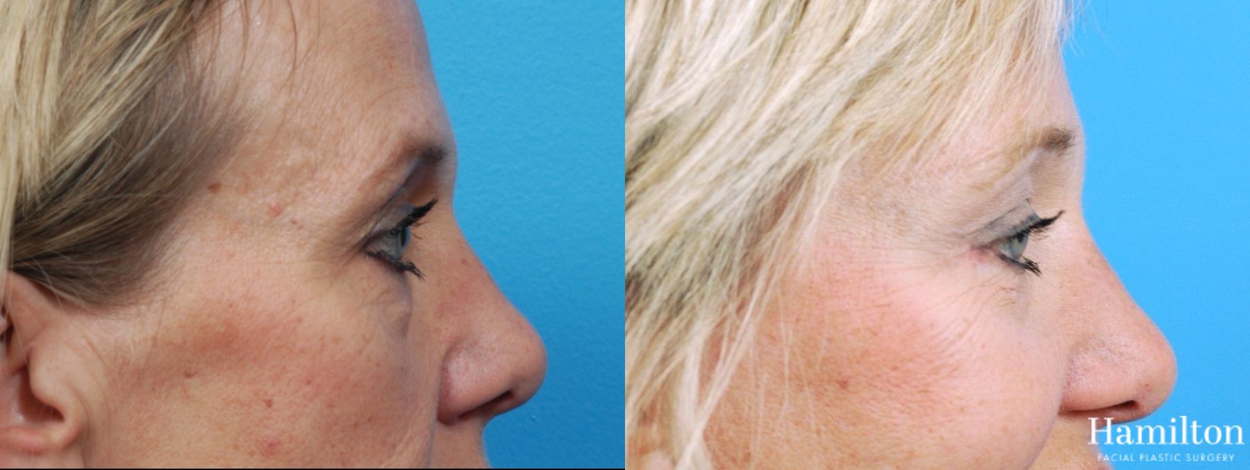 Before and after Blepharoplasty case 37216 - Angle 3