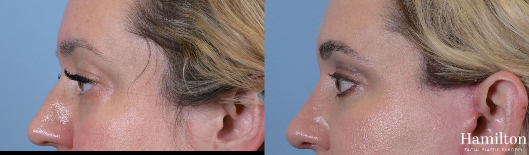 Before and after Blepharoplasty case 37133 - Angle 5