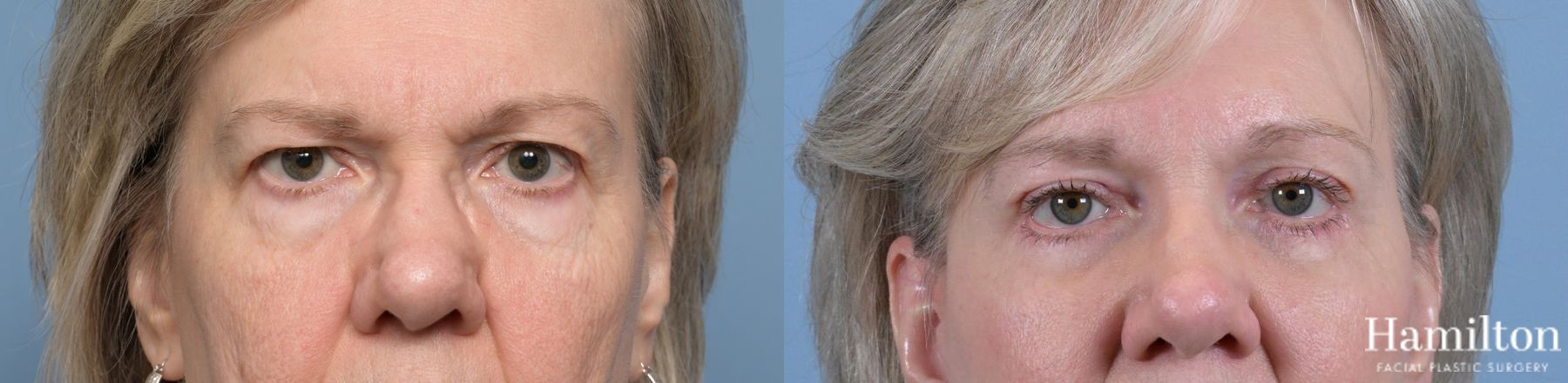 Before and after Blepharoplasty case 37195