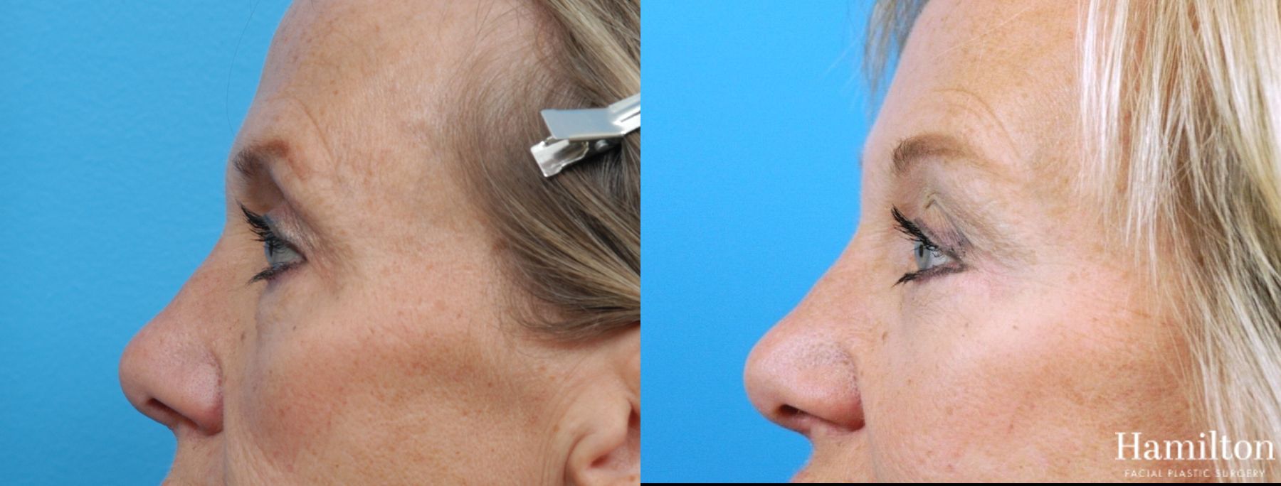 Before and after Blepharoplasty case 37216 - Angle 2
