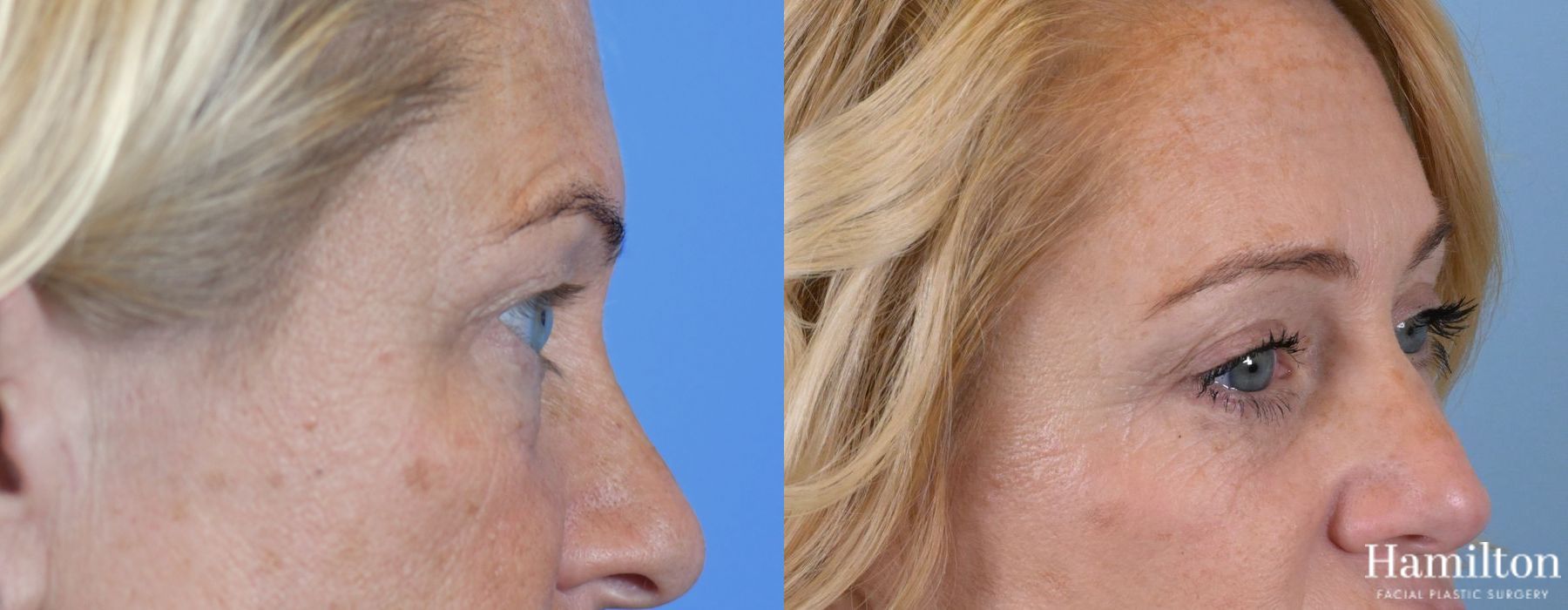 Before and after Blepharoplasty case 37289 - Angle 4