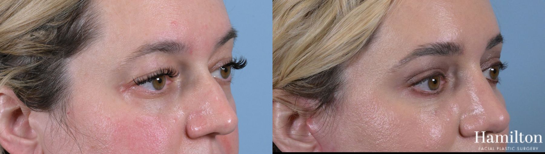 Before and after Blepharoplasty case 37133 - Angle 2