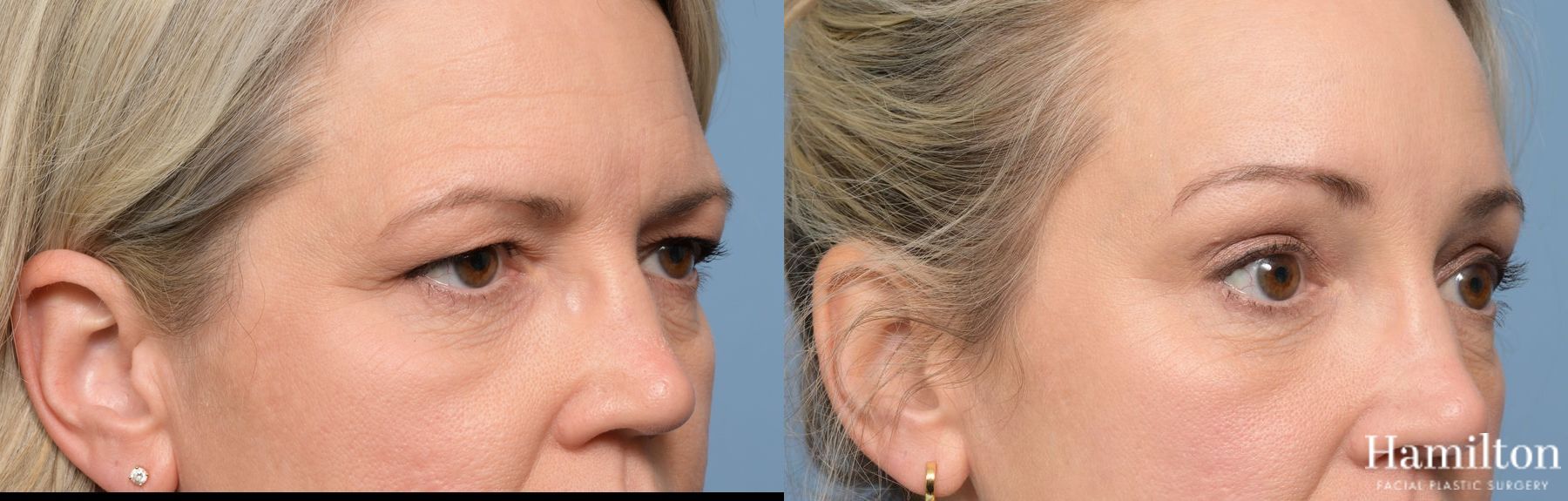 Before and after Blepharoplasty case 37175 - Angle 5