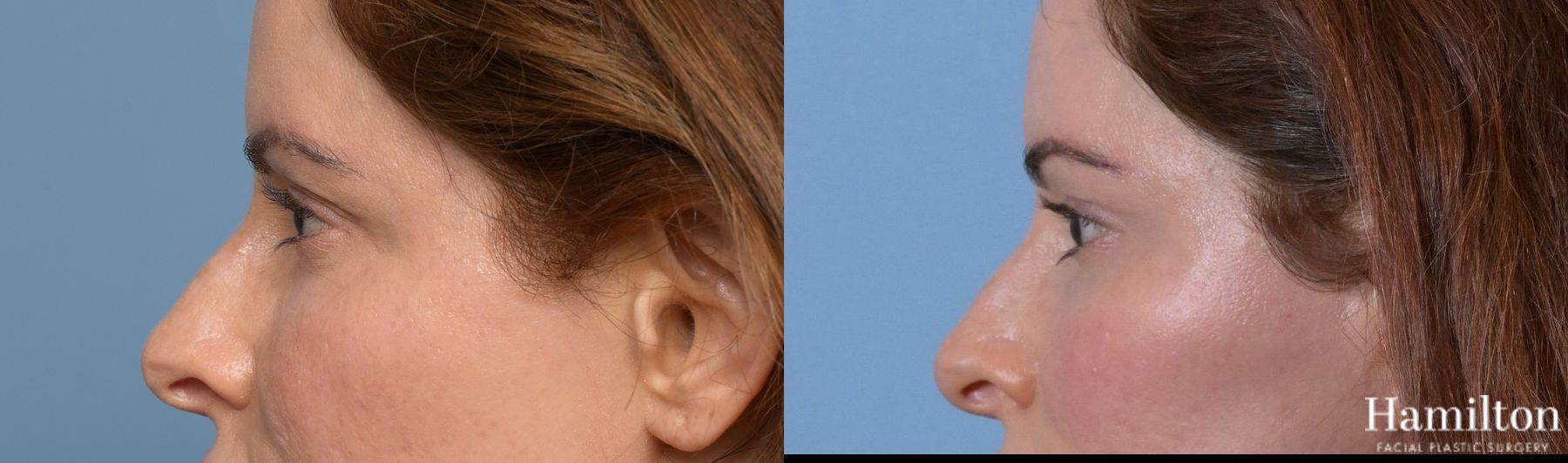 Before and after Blepharoplasty case 37169 - Angle 3