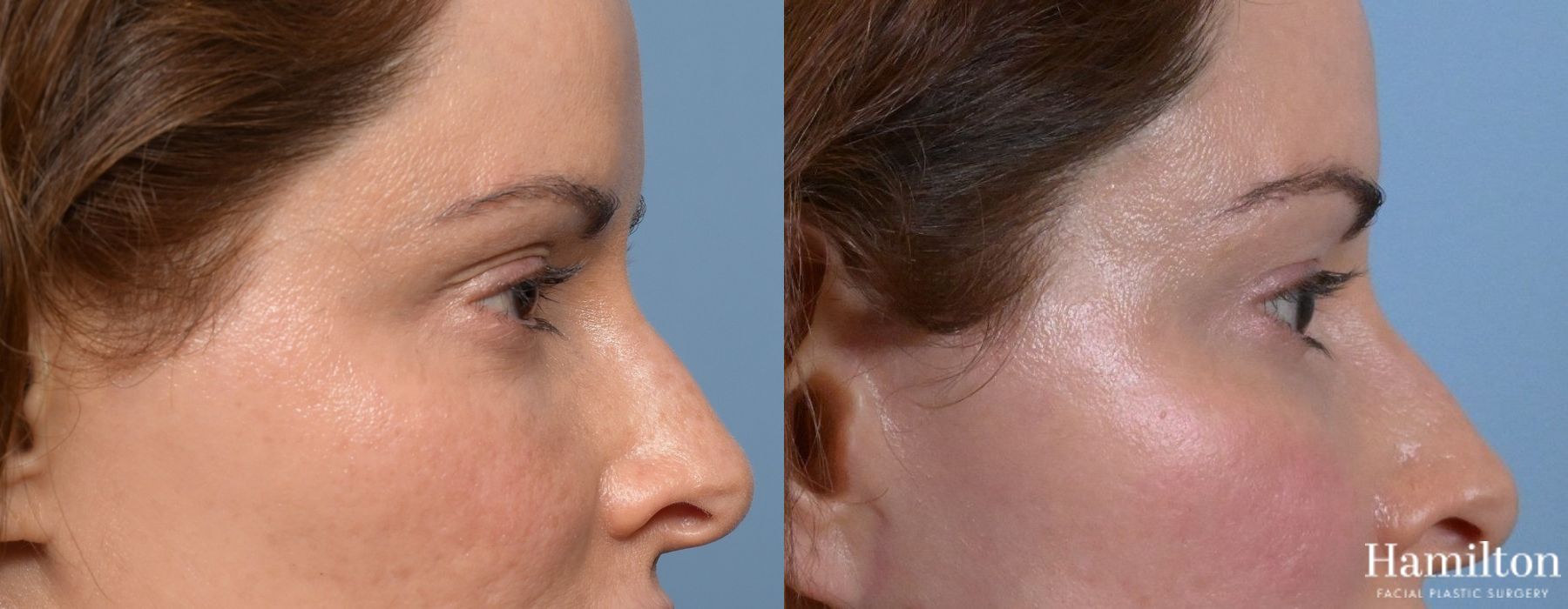Before and after Blepharoplasty case 37169 - Angle 5