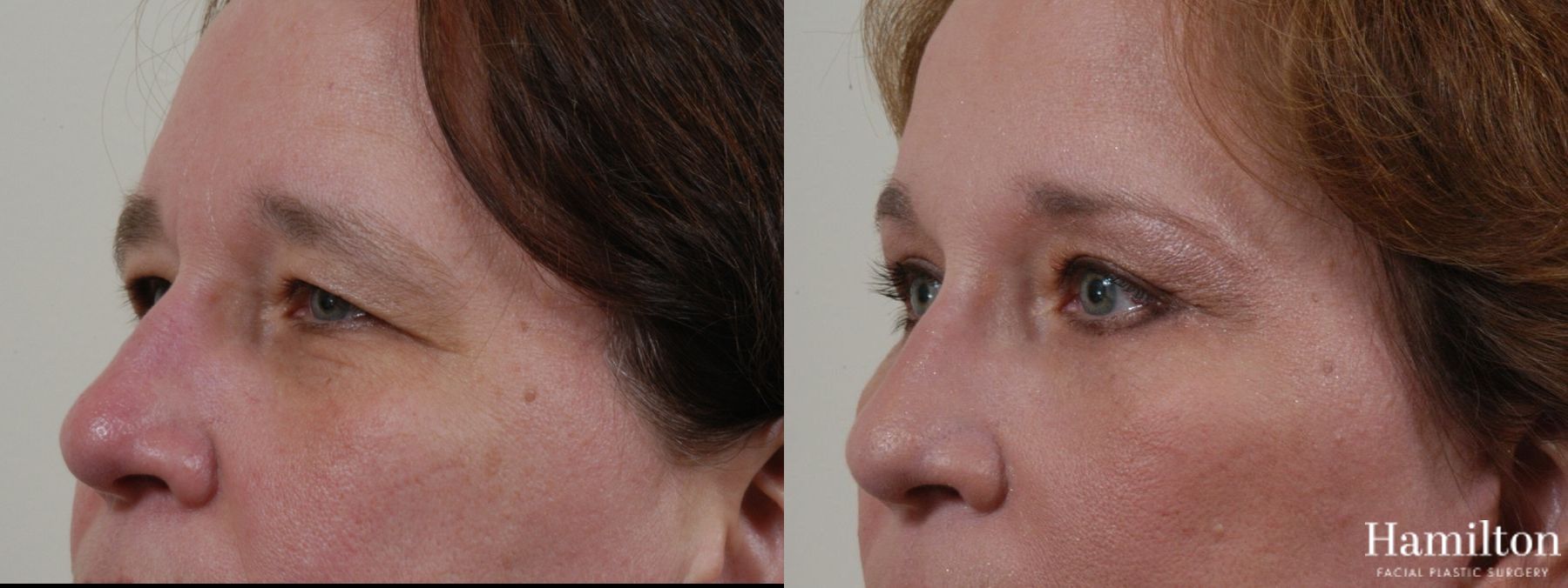 Before and after Blepharoplasty case 37270 - Angle 2