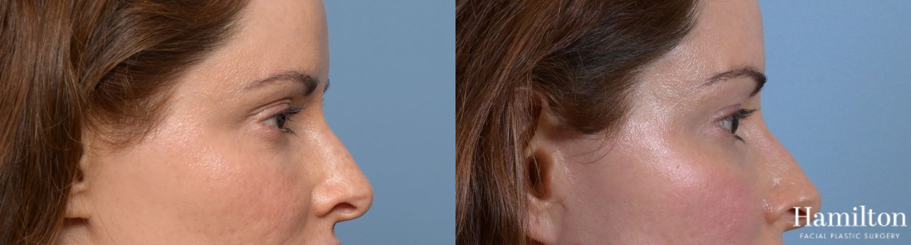 Before and after Blepharoplasty case 37169 - Angle 5